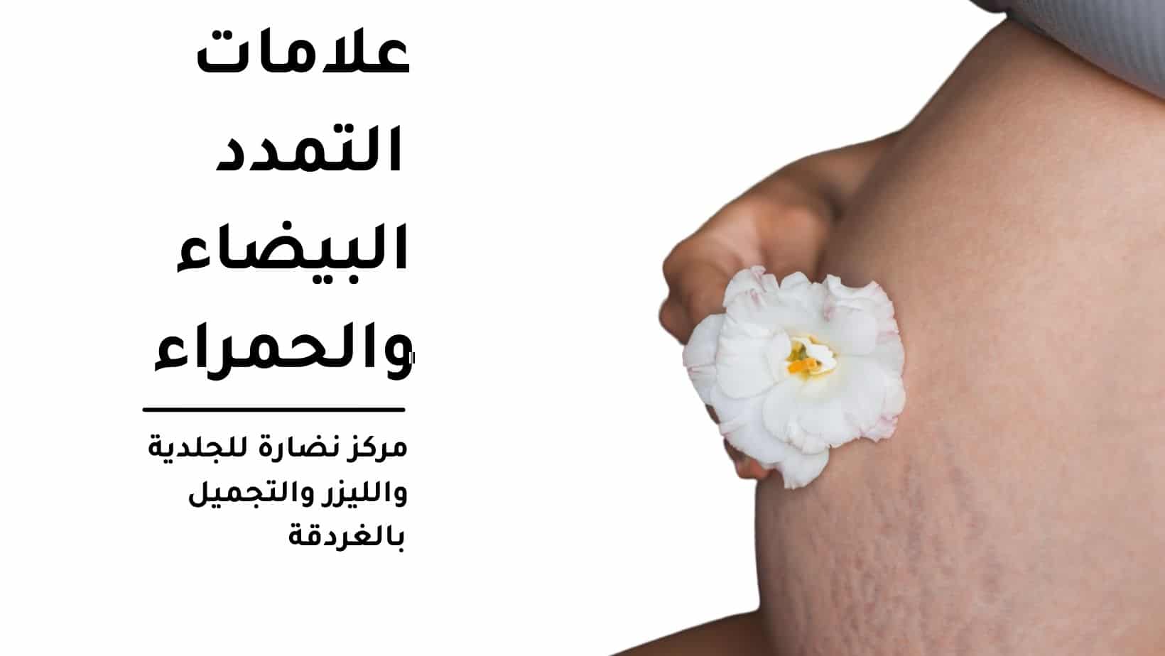 White and red stretch marks